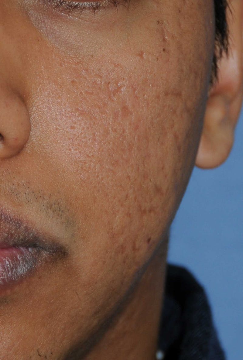 Acne Scar Treatment Before & After Gallery - Patient 181891 - Image 5