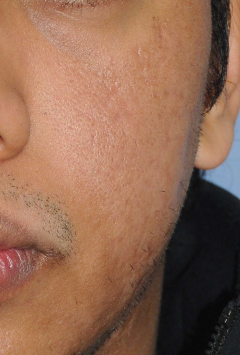 Acne Scar Treatment Before & After Gallery - Patient 181891 - Image 6