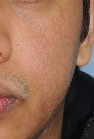Acne Scar Treatment Before & After Gallery - Patient 181891 - Image 6