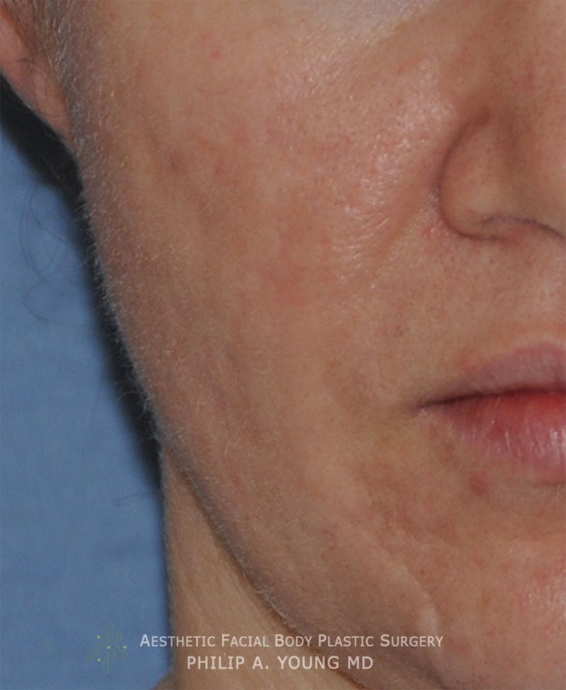 Acne Scar Treatment Before & After Gallery - Patient 325942 - Image 1