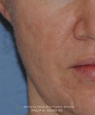 Acne Scar Treatment Before & After Gallery - Patient 325942 - Image 1