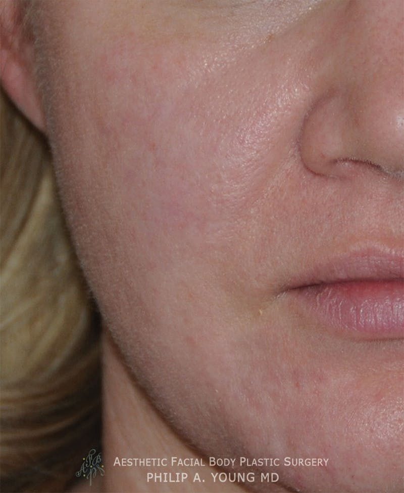 Acne Scar Treatment Before & After Gallery - Patient 325942 - Image 2