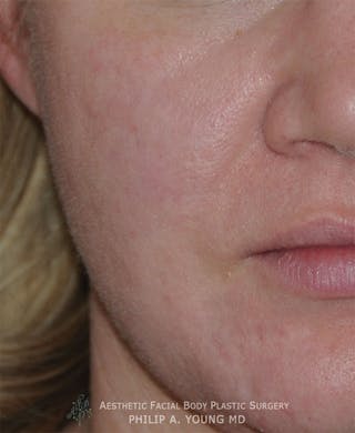 Acne Scar Treatment Before & After Gallery - Patient 325942 - Image 2