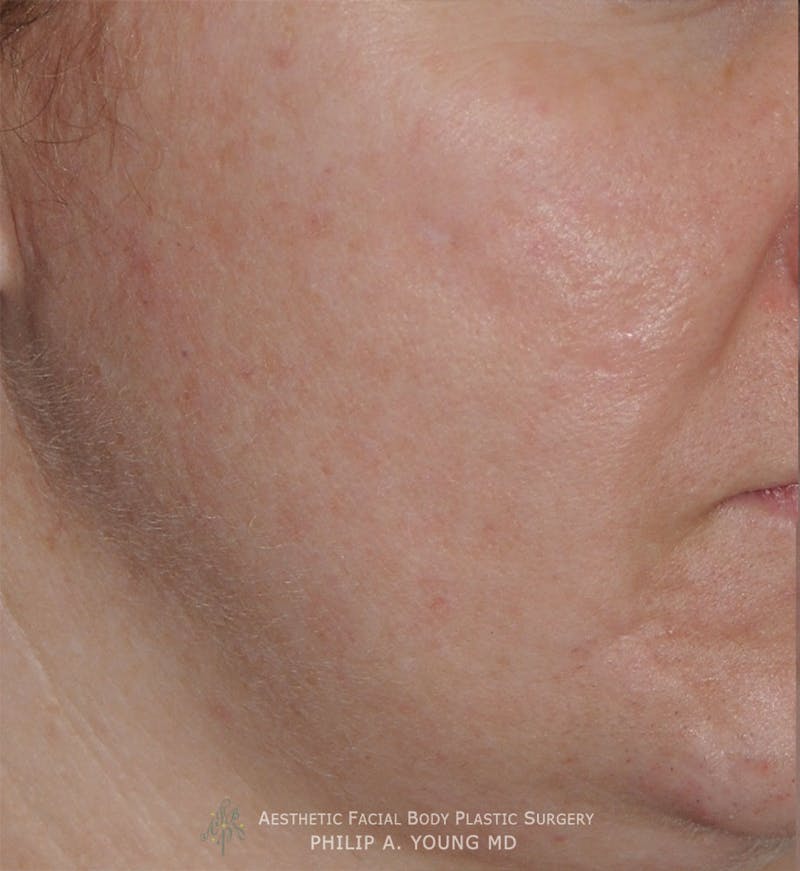 Acne Scar Treatment Before & After Gallery - Patient 325942 - Image 3