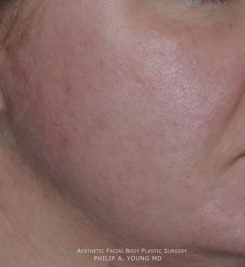 Acne Scar Treatment Before & After Gallery - Patient 325942 - Image 4