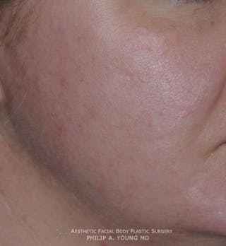 Acne Scar Treatment Before & After Gallery - Patient 325942 - Image 4