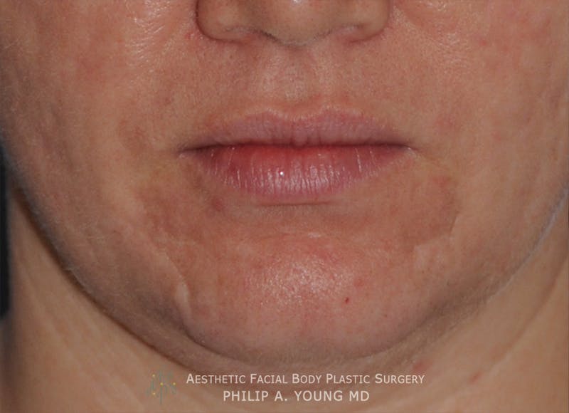 Acne Scar Treatment Before & After Gallery - Patient 325942 - Image 5