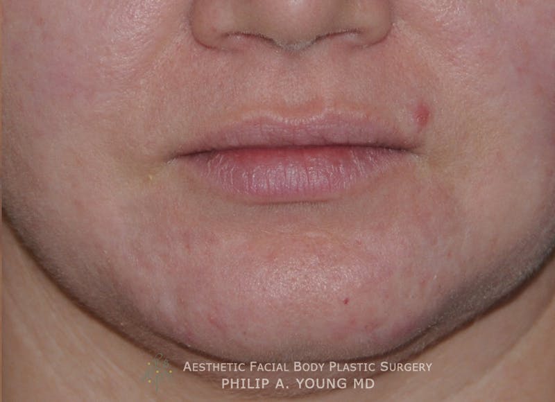 Acne Scar Treatment Before & After Gallery - Patient 325942 - Image 6