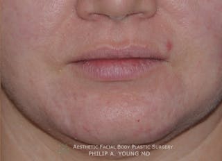 Acne Scar Treatment Before & After Gallery - Patient 325942 - Image 6