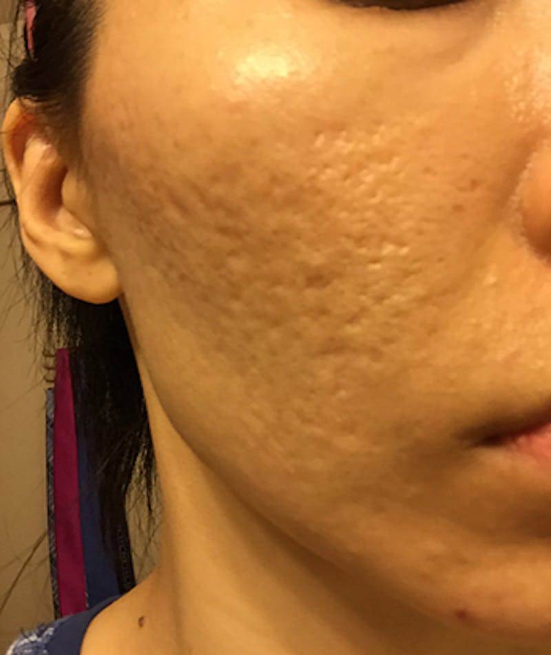 Scar Revision Before & After Gallery - Patient 164459 - Image 1
