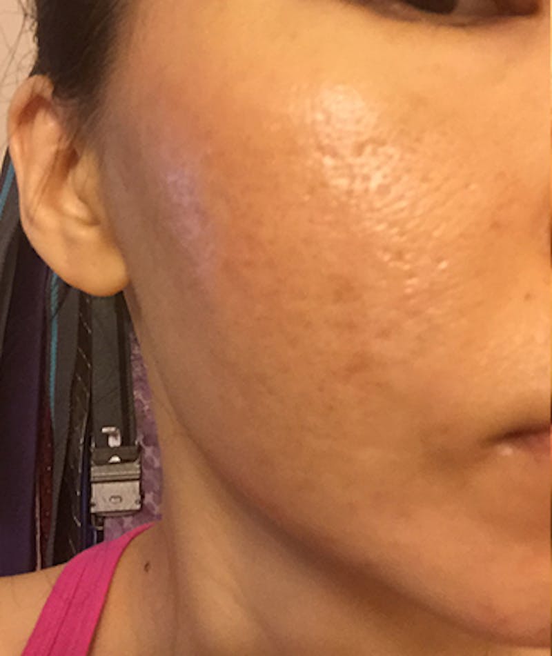 Scar Revision Before & After Gallery - Patient 164459 - Image 2