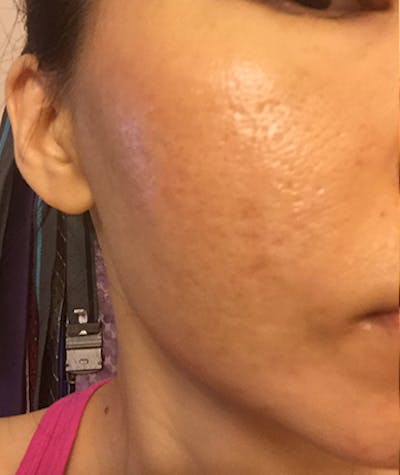 Acne Scar Treatment Before & After Gallery - Patient 367254 - Image 2