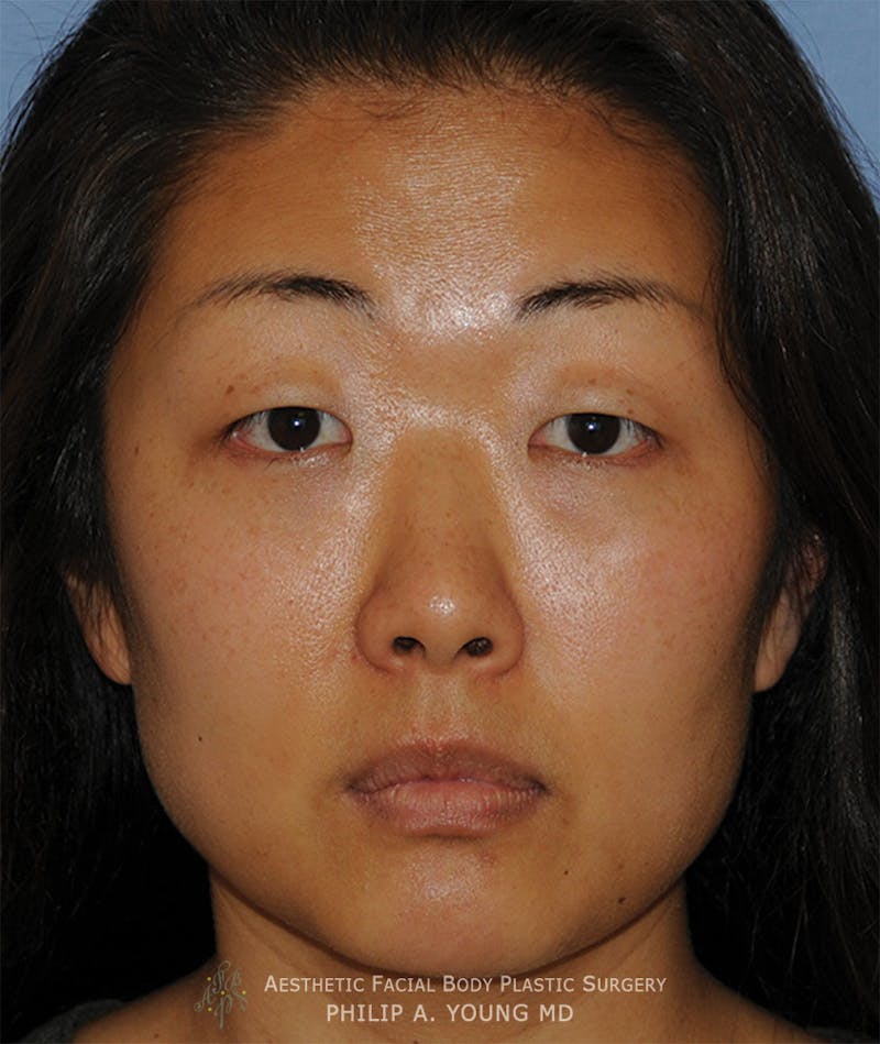 Asian / Ethnic Surgery Before & After Gallery - Patient 381417 - Image 1