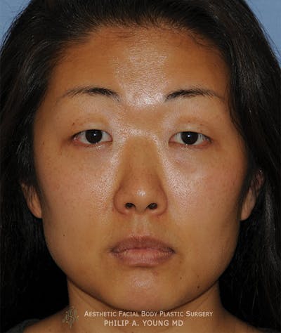 Asian / Ethnic Surgery Before & After Gallery - Patient 381417 - Image 1