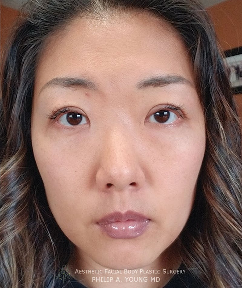 Asian / Ethnic Surgery Before & After Gallery - Patient 381417 - Image 2