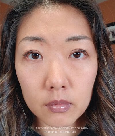 Asian / Ethnic Surgery Before & After Gallery - Patient 381417 - Image 2