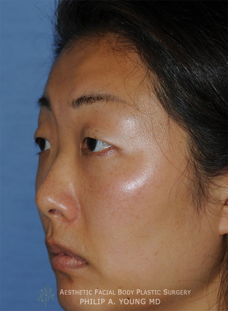 Asian / Ethnic Surgery Before & After Gallery - Patient 381417 - Image 3
