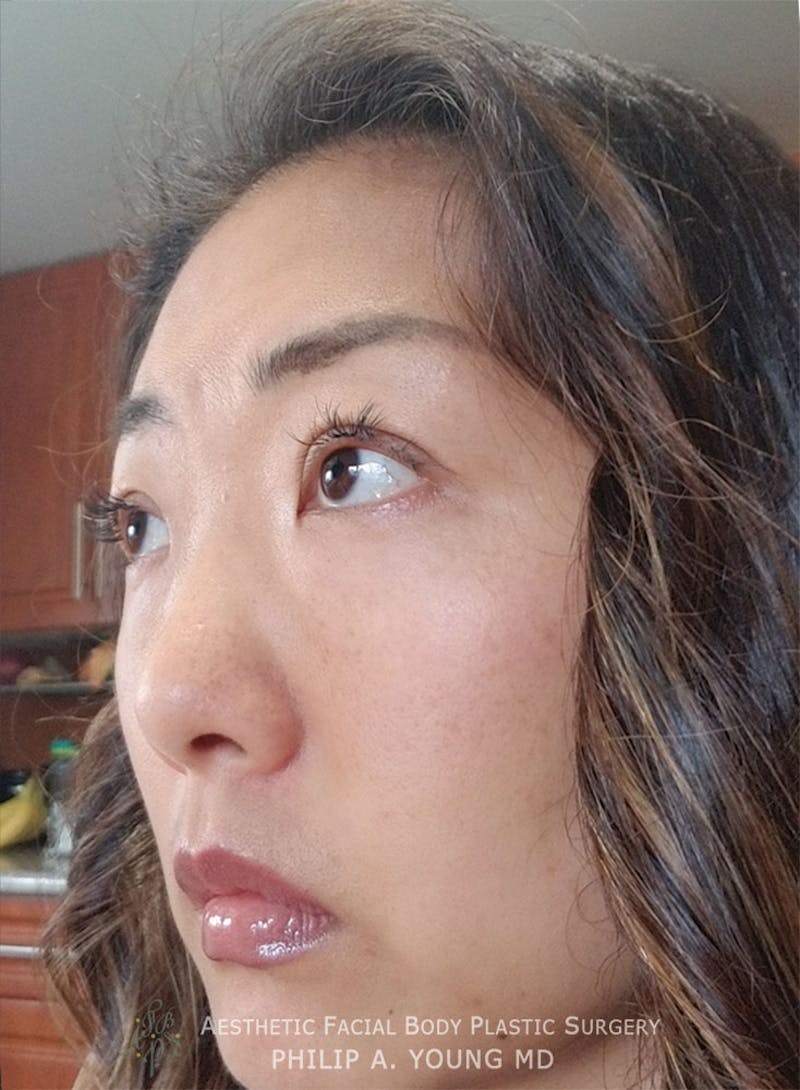 Asian / Ethnic Surgery Before & After Gallery - Patient 381417 - Image 4