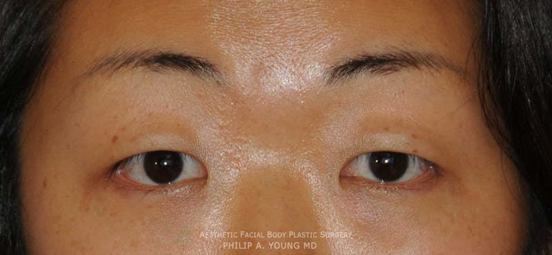 Asian / Ethnic Surgery Before & After Gallery - Patient 381417 - Image 5