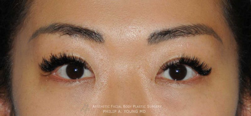 Asian / Ethnic Surgery Before & After Gallery - Patient 381417 - Image 6