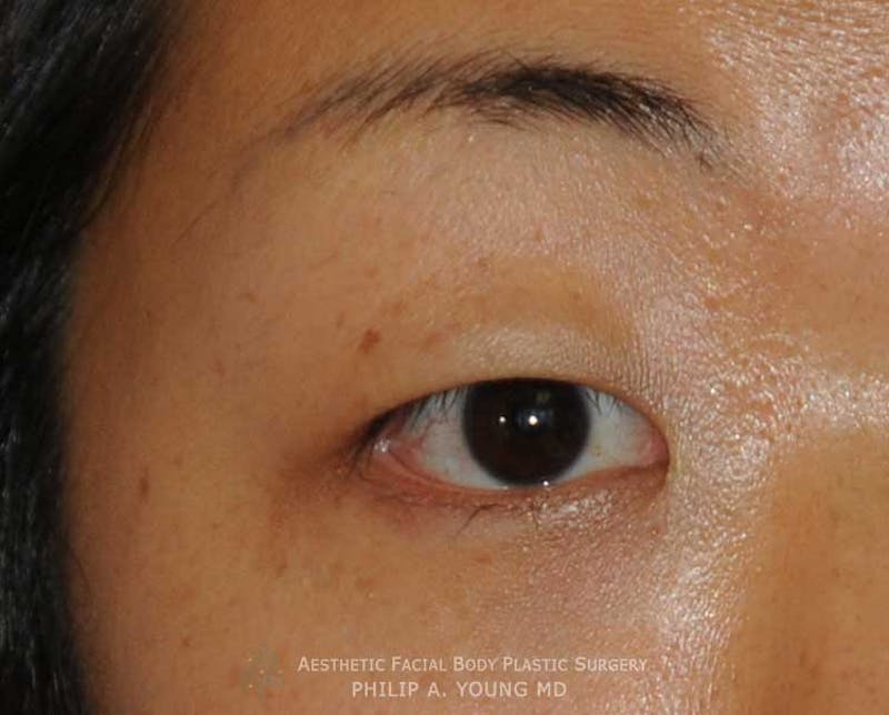 Asian / Ethnic Surgery Before & After Gallery - Patient 381417 - Image 7