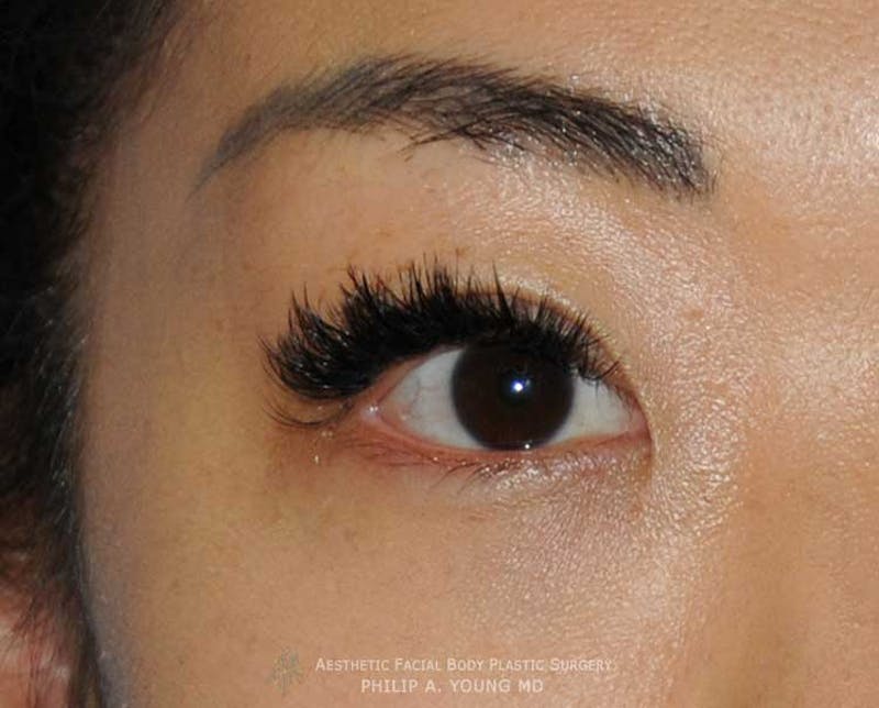 Asian / Ethnic Surgery Before & After Gallery - Patient 381417 - Image 8