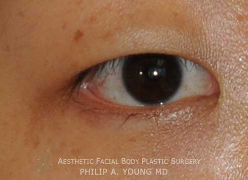 Asian / Ethnic Surgery Before & After Gallery - Patient 381417 - Image 9