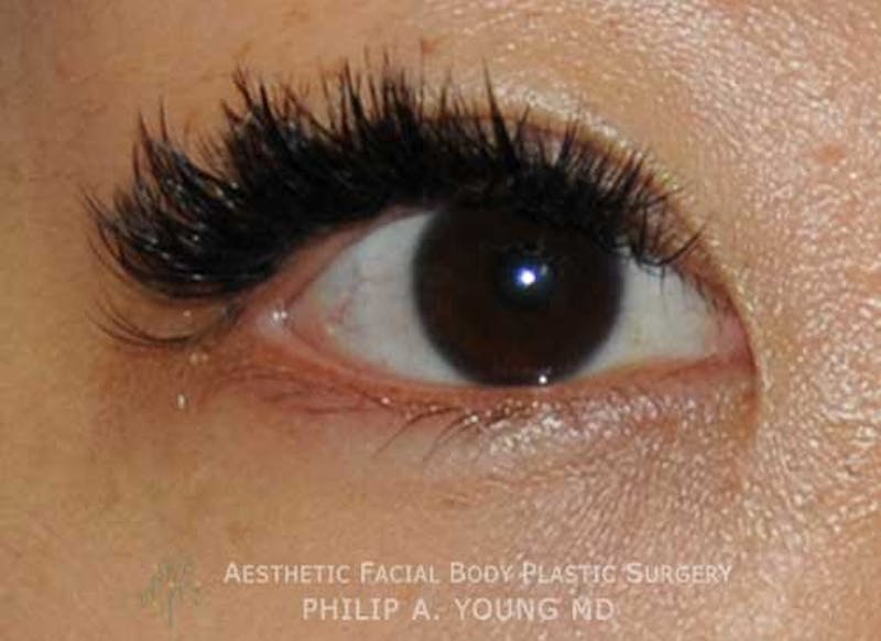 Asian / Ethnic Surgery Before & After Gallery - Patient 381417 - Image 10