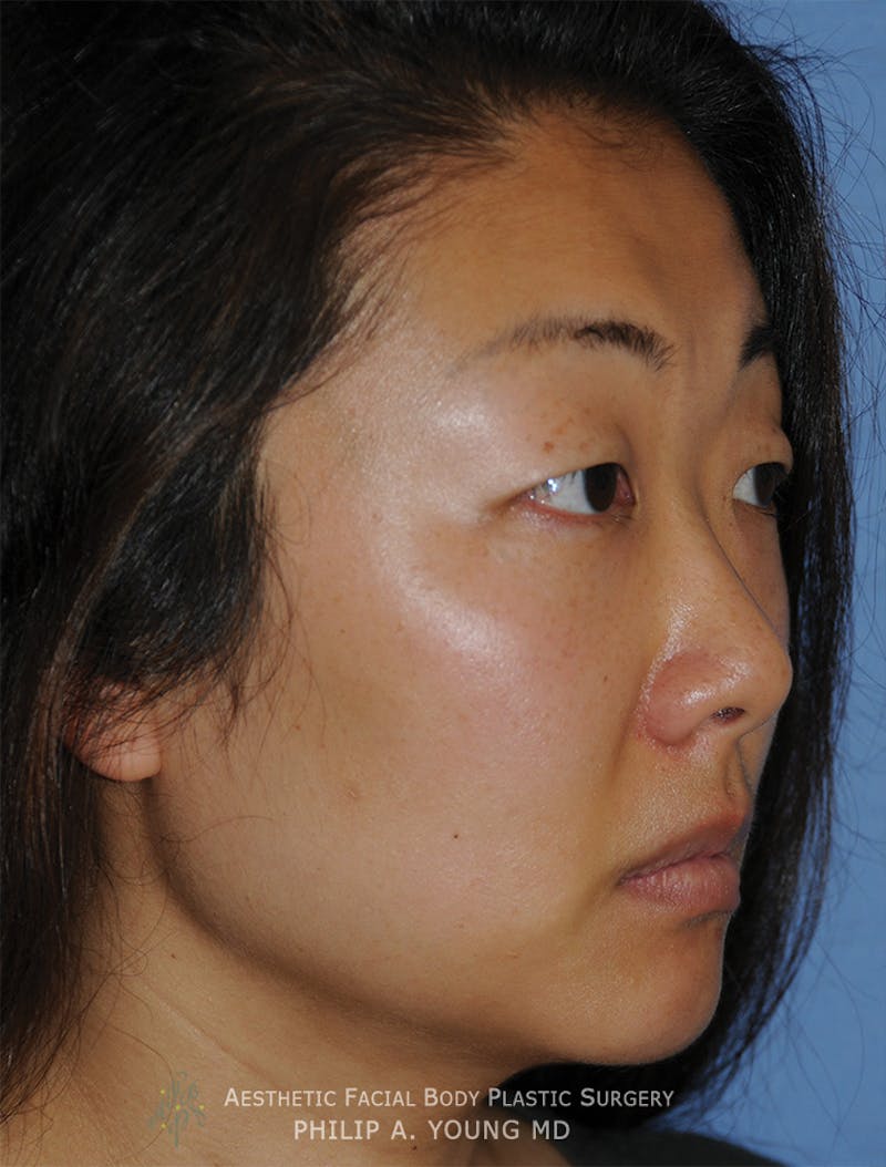 Asian / Ethnic Surgery Before & After Gallery - Patient 381417 - Image 11