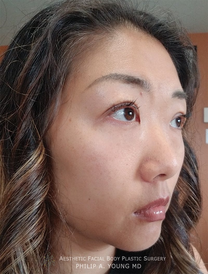 Asian / Ethnic Surgery Before & After Gallery - Patient 381417 - Image 12