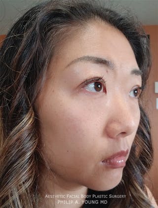 Asian / Ethnic Surgery Before & After Gallery - Patient 381417 - Image 12