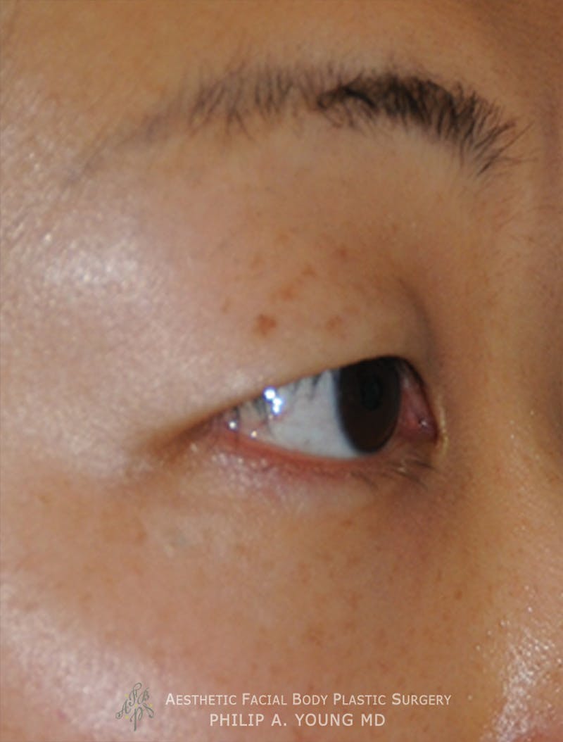Asian / Ethnic Surgery Before & After Gallery - Patient 381417 - Image 13