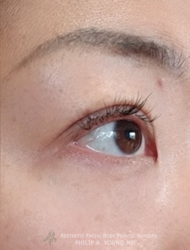 Asian / Ethnic Surgery Before & After Gallery - Patient 381417 - Image 14