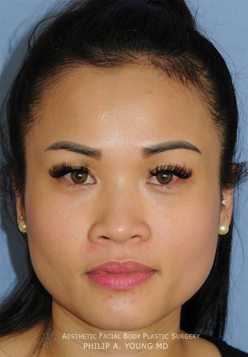 Asian Rhinoplasty Before & After Gallery - Patient 218400 - Image 1