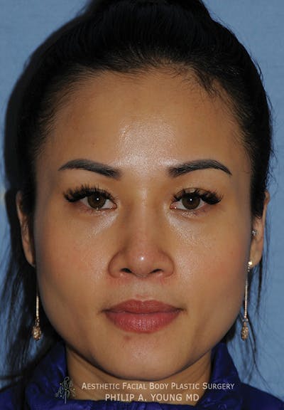 Rhinoplasty Before & After Gallery - Patient 209685 - Image 2