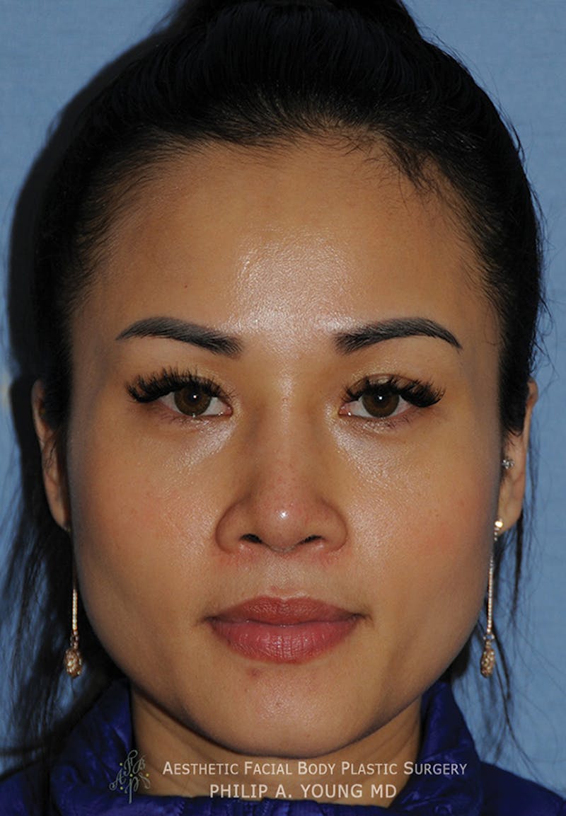 Asian Rhinoplasty Before & After Gallery - Patient 218400 - Image 2