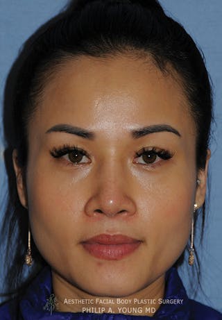 Asian Rhinoplasty Before & After Gallery - Patient 218400 - Image 2
