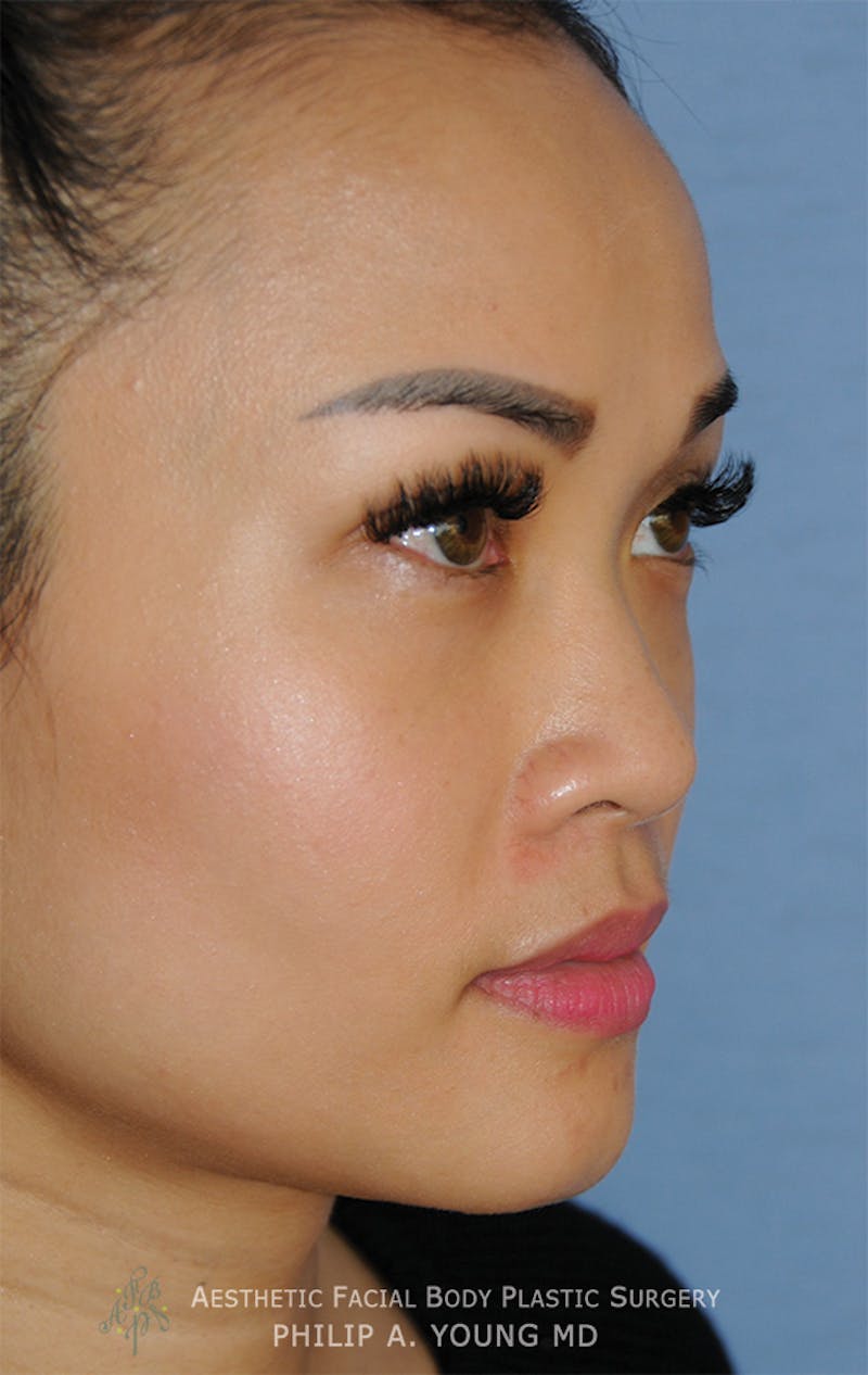 Asian Rhinoplasty Before & After Gallery - Patient 218400 - Image 3