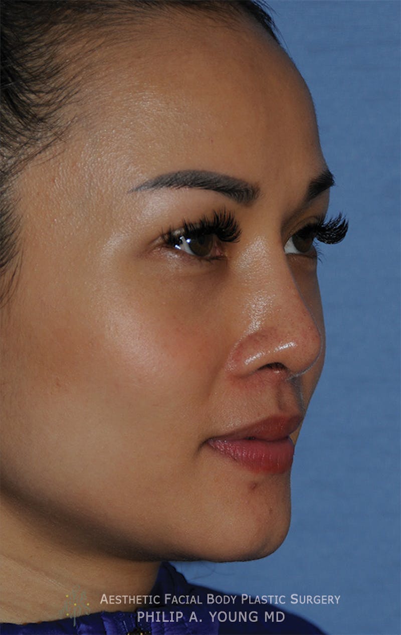 Asian Rhinoplasty Before & After Gallery - Patient 218400 - Image 4