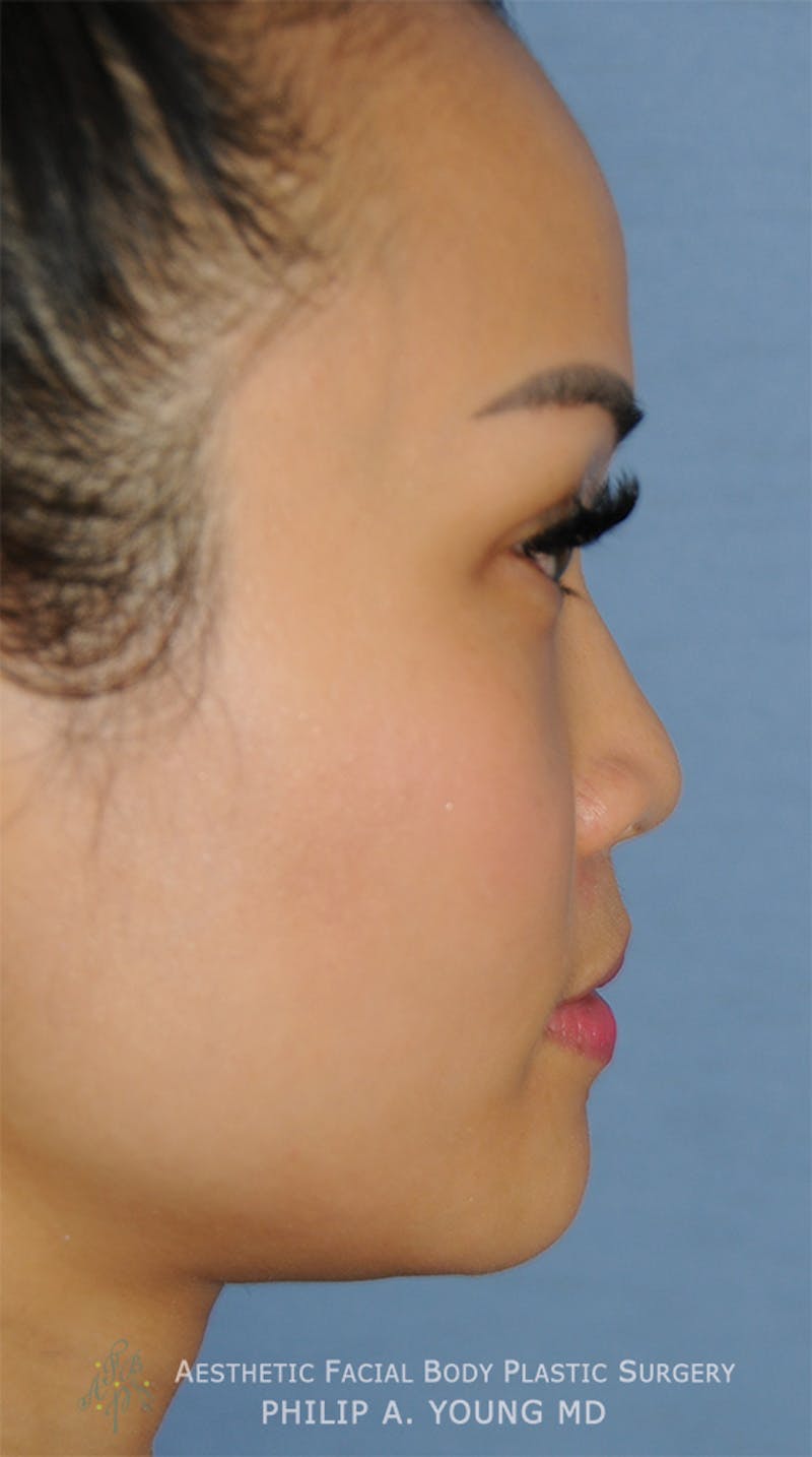 Asian Rhinoplasty Before & After Gallery - Patient 218400 - Image 5
