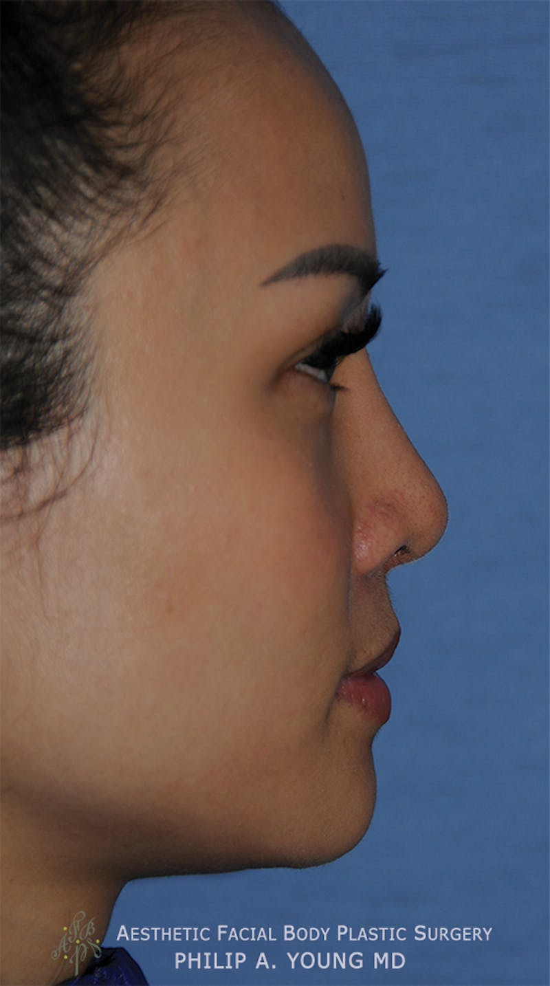 Asian Rhinoplasty Before & After Gallery - Patient 218400 - Image 6