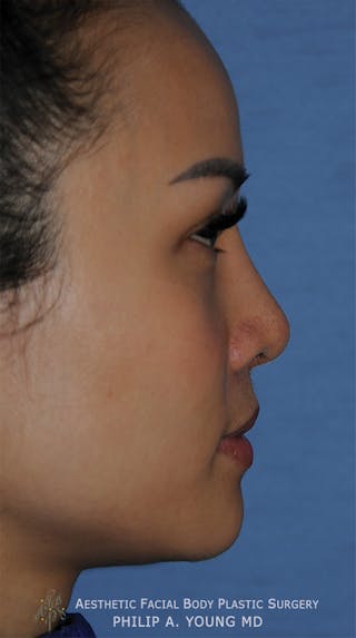Asian Rhinoplasty Before & After Gallery - Patient 218400 - Image 6