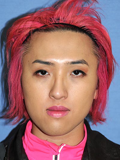 Asian / Ethnic Surgery Before & After Gallery - Patient 105260 - Image 1