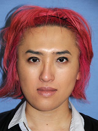 Chin Implant Reshaping Before & After Gallery - Patient 270393 - Image 2
