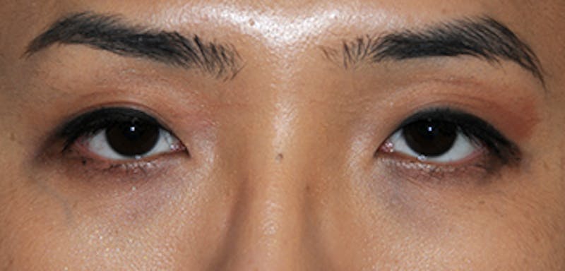Eye Lift Before & After Gallery - Patient 122630 - Image 1