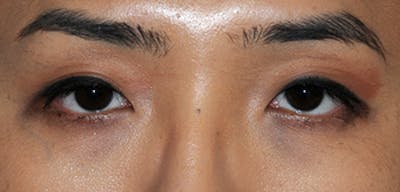 Eye Lift Before & After Gallery - Patient 122630 - Image 1