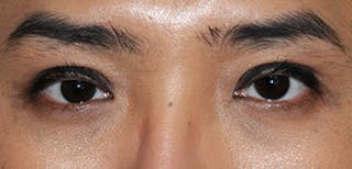 Asian / Ethnic Surgery Before & After Gallery - Patient 105260 - Image 4