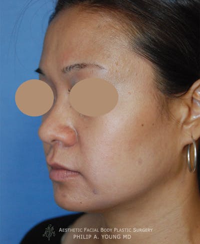 Rhinoplasty Before & After Gallery - Patient 400739 - Image 1