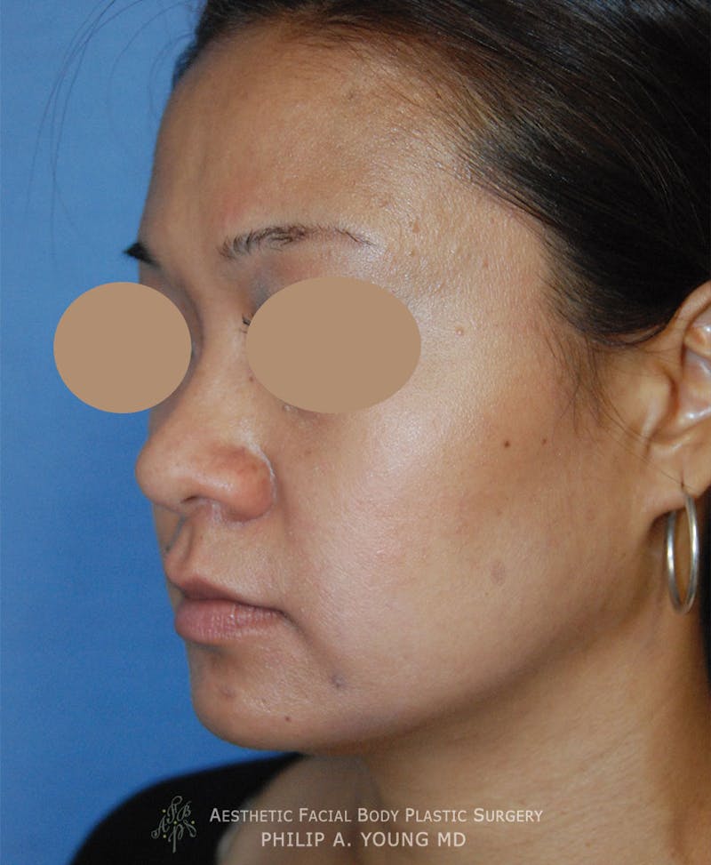 Asian Rhinoplasty Before & After Gallery - Patient 213701 - Image 1
