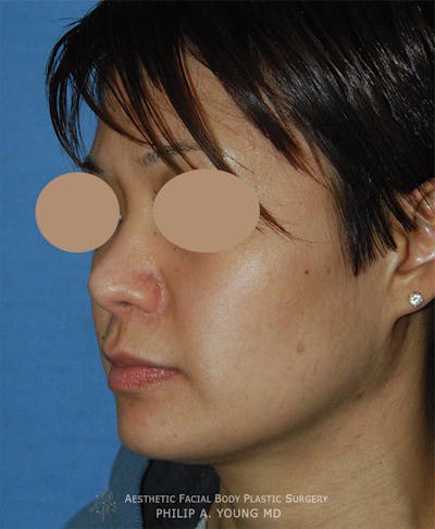 Rhinoplasty Before & After Gallery - Patient 400739 - Image 2